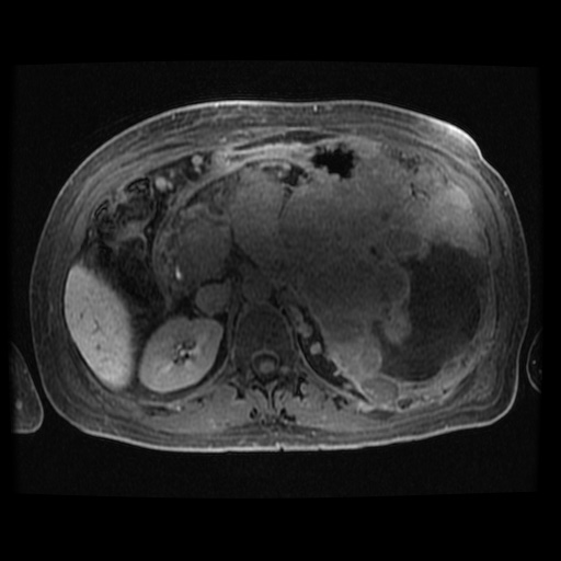 Acinar cell carcinoma of the pancreas (Radiopaedia 75442-86668 Axial late phase (~30 mins) 61).jpg
