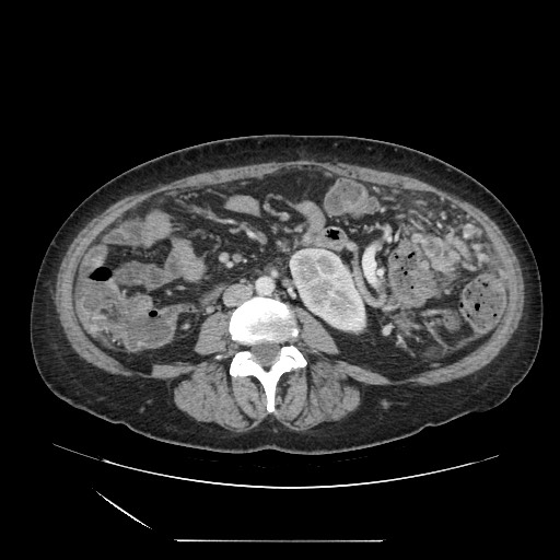File:Acinar cell carcinoma of the pancreas (Radiopaedia 75442-86669 Axial C+ portal venous phase 82).jpg