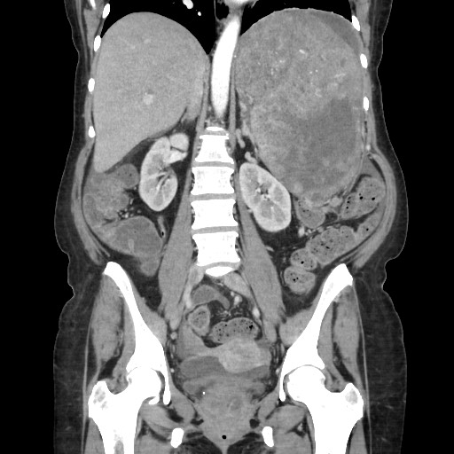 Acinar cell carcinoma of the pancreas (Radiopaedia 75442-86669 Coronal C+ portal venous phase 75).jpg