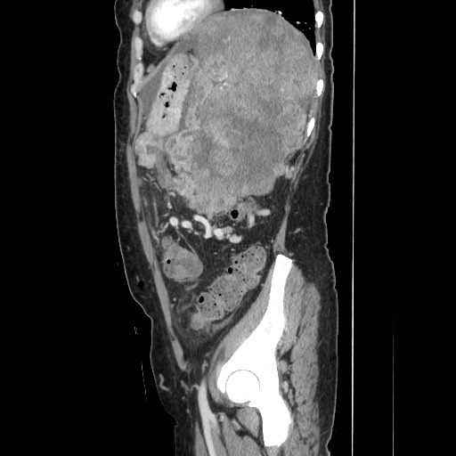 File:Acinar cell carcinoma of the pancreas (Radiopaedia 75442-86669 Sagittal C+ portal venous phase 140).jpg
