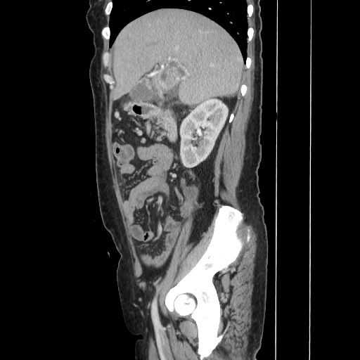 Acinar cell carcinoma of the pancreas (Radiopaedia 75442-86669 Sagittal C+ portal venous phase 65).jpg