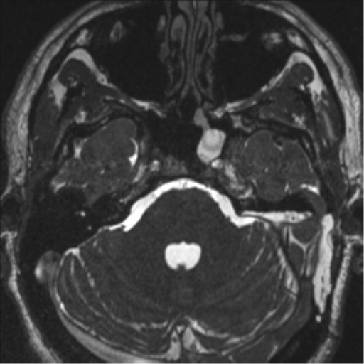 Acoustic schwannoma (translabyrinthine resection) (Radiopaedia 43570-46972 Axial CISS 33).png