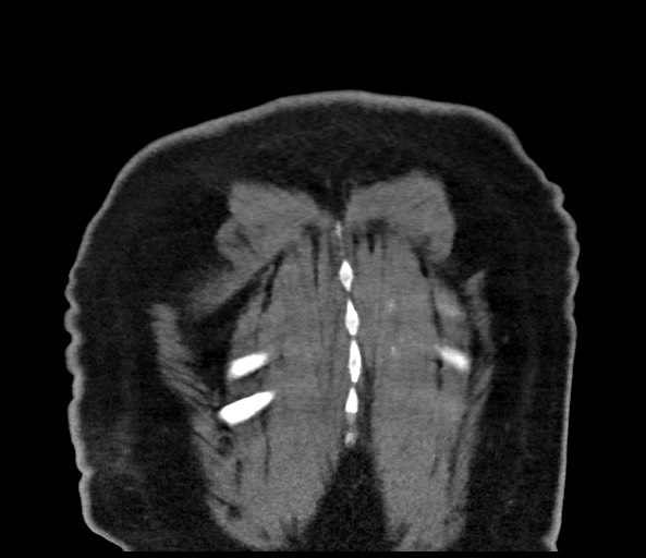File:Acromioclavicular joint cyst (Radiopaedia 58455-65610 Coronal 110).jpg