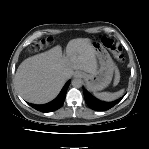 Active colonic bleed on CT (Radiopaedia 49765-55025 Axial non-contrast 12).jpg