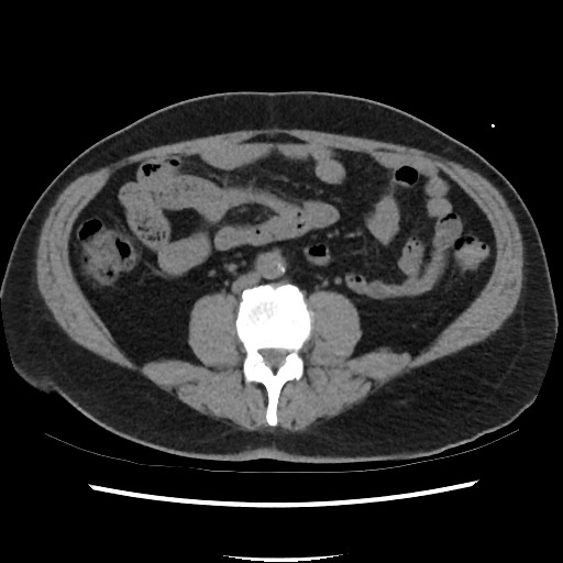 File:Active colonic bleed on CT (Radiopaedia 49765-55025 Axial non-contrast 45).jpg