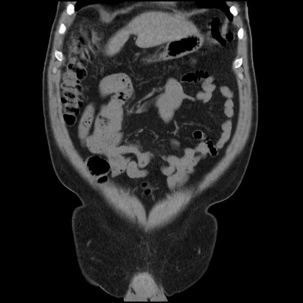 Active colonic bleed on CT (Radiopaedia 49765-55025 Coronal non-contrast 15).jpg