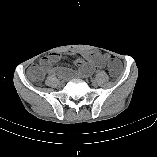 Active crohn disease (Radiopaedia 87133-103397 Axial non-contrast 75).jpg