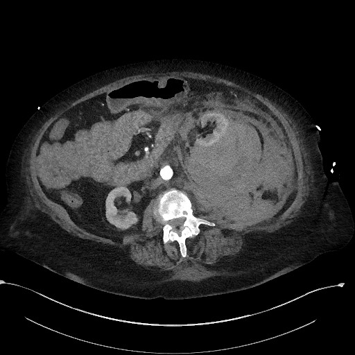 File:Active renal extravasation with large subcapsular and retroperitoneal hemorrhage (Radiopaedia 60975-68796 Axial 41).jpg