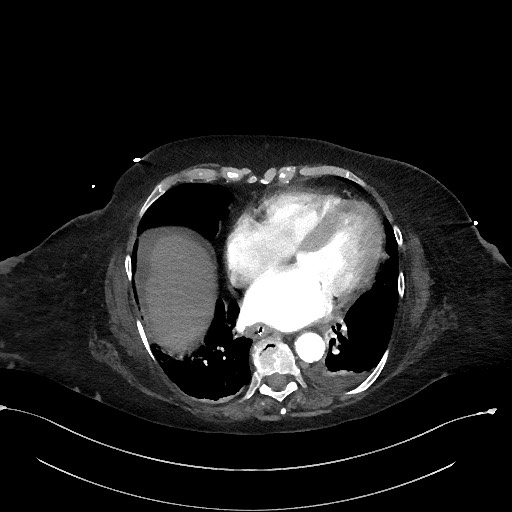 Active renal extravasation with large subcapsular and retroperitoneal hemorrhage (Radiopaedia 60975-68796 Axial C+ arterial phase 13).jpg