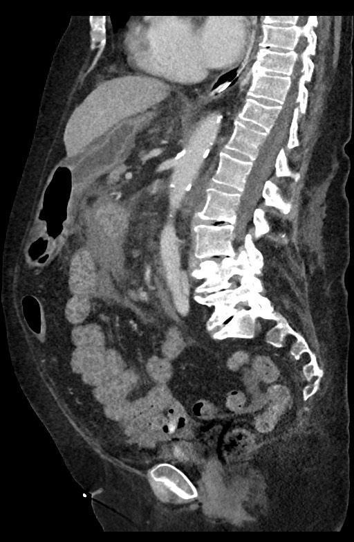 Active renal extravasation with large subcapsular and retroperitoneal hemorrhage (Radiopaedia 60975-68796 Sagittal C+ portal venous phase 121).jpg