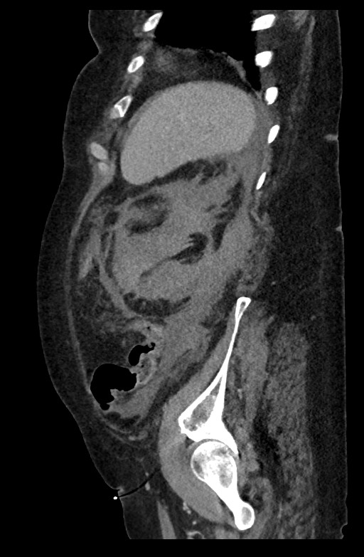Active renal extravasation with large subcapsular and retroperitoneal hemorrhage (Radiopaedia 60975-68796 Sagittal C+ portal venous phase 64).jpg
