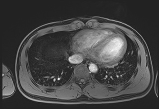 File:Active right ventricular cardiac sarcoidosis (Radiopaedia 55596-62100 Axial Post contrast Dixon 57).jpg