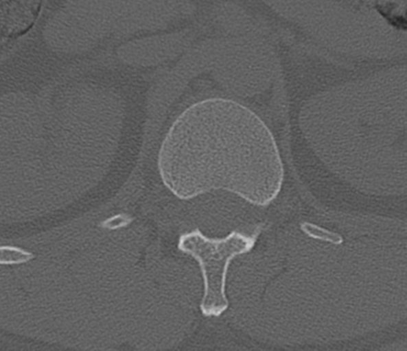 File:Acute L1 burst compression fracture (Radiopaedia 34430-35755 Axial bone window 14).png