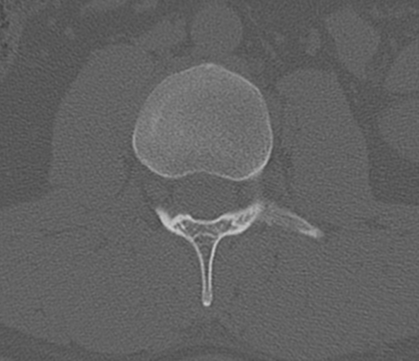 File:Acute L1 burst compression fracture (Radiopaedia 34430-35755 Axial bone window 38).png