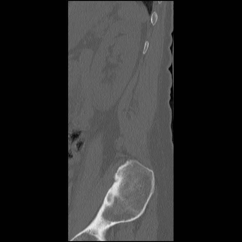 Acute Schmorl's node (Radiopaedia 83276-102365 Sagittal bone window 12).jpg