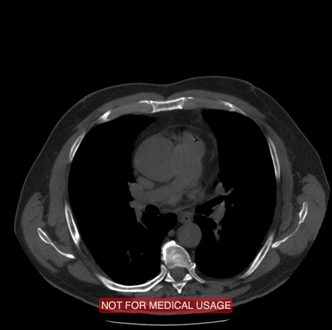 Acute aortic dissection - Stanford type A (Radiopaedia 40661-43285 Axial non-contrast 25).jpg