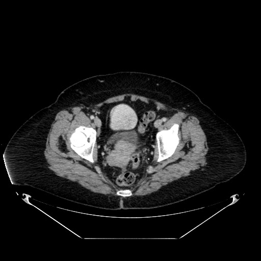 File:Acute appendicitis, heterotaxy syndrome (Radiopaedia 66884-76202 Axial C+ portal venous phase 117).jpg