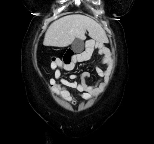 Acute appendicitis, heterotaxy syndrome (Radiopaedia 66884-76202 Coronal C+ portal venous phase 25).jpg