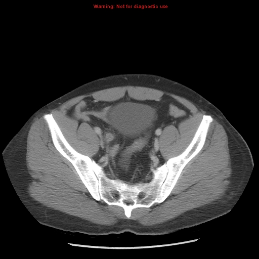 Acute appendicitis (Radiopaedia 10498-10973 Axial C+ portal venous phase 40).jpg