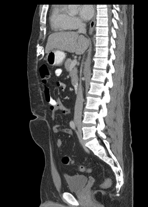 Acute appendicitis (Radiopaedia 48511-53463 Sagittal C+ portal venous phase 69).jpg