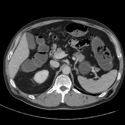 File:Acute appendicitis (Radiopaedia 66513-75790 Axial C+ portal venous phase 15).jpg