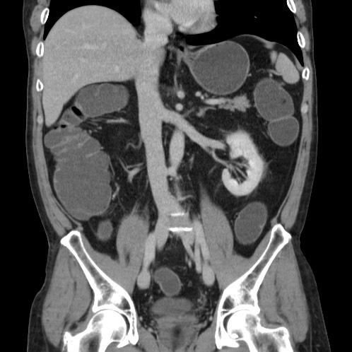 Acute appendicitis (Radiopaedia 66513-75790 Coronal C+ portal venous phase 42).jpg