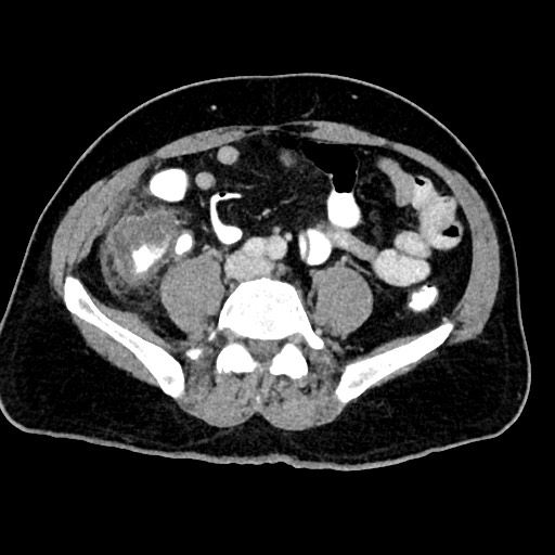 Acute appendicitis (Radiopaedia 77016-88960 Axial C+ portal venous phase 93).jpg