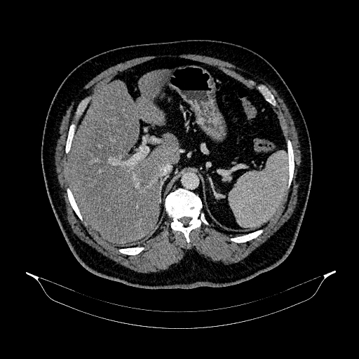 File:Acute appendicitis (Radiopaedia 79950-93224 Axial C+ portal venous phase 28).jpg