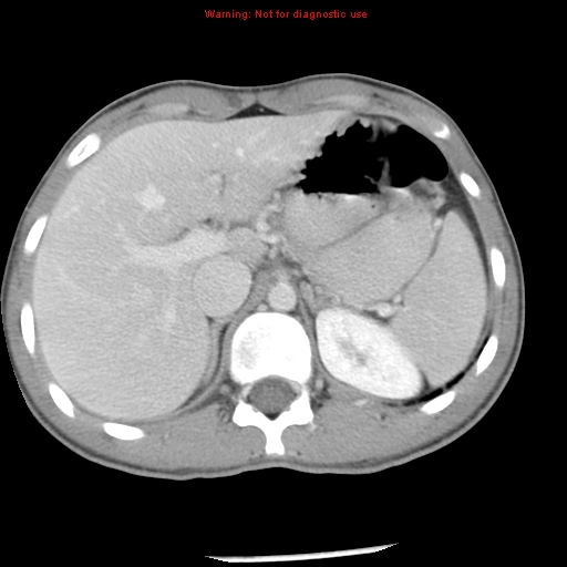 Acute appendicitis (Radiopaedia 8195-9045 Axial C+ portal venous phase 17).jpg