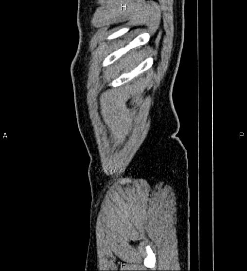 File:Acute appendicitis (Radiopaedia 84780-100240 Sagittal C+ portal venous phase 2).jpg