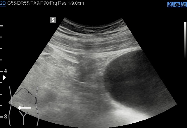 File:Acute appendicitis (Radiopaedia 85193-100745 B 168).jpg