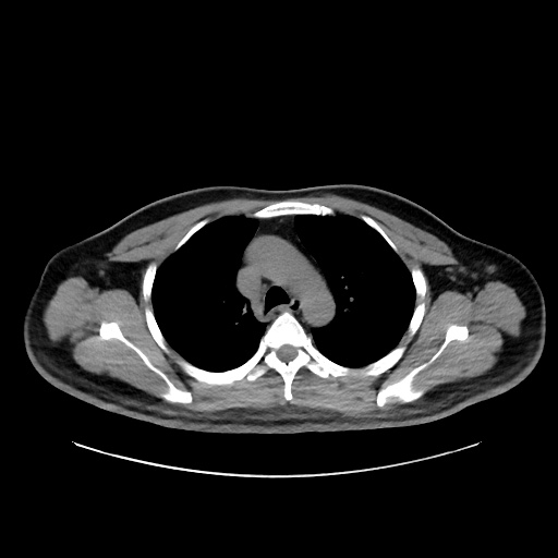 Acute appendicitis and COVID 19 pneumonia (Radiopaedia 76604-88380 Axial non-contrast 18).jpg