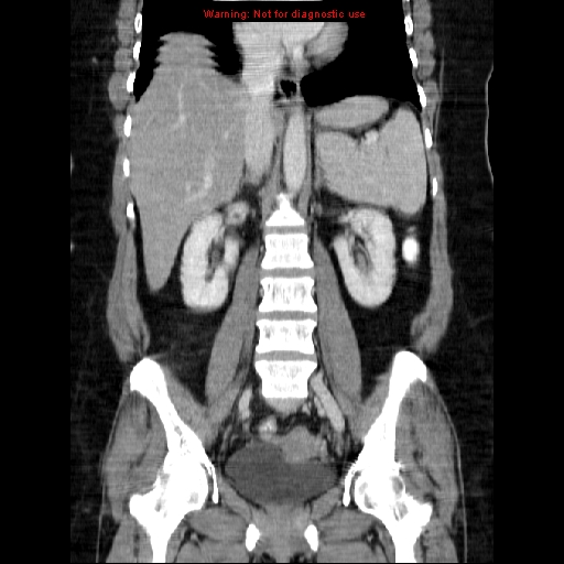 Acute appendicitis complicated by ovarian vein thrombophlebitis (Radiopaedia 16172-15851 Coronal C+ portal venous phase 49).jpg