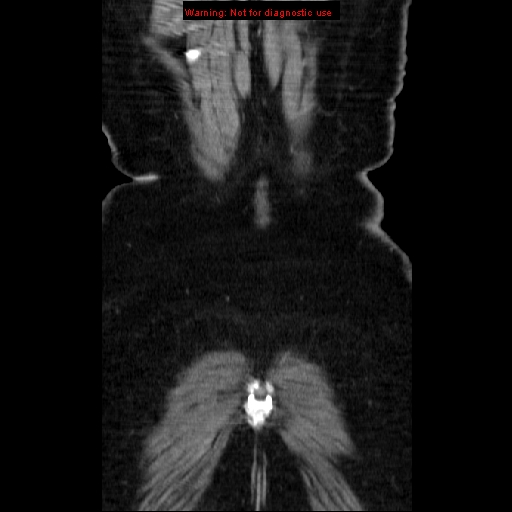 Acute appendicitis complicated by ovarian vein thrombophlebitis (Radiopaedia 16172-15851 Coronal C+ portal venous phase 80).jpg