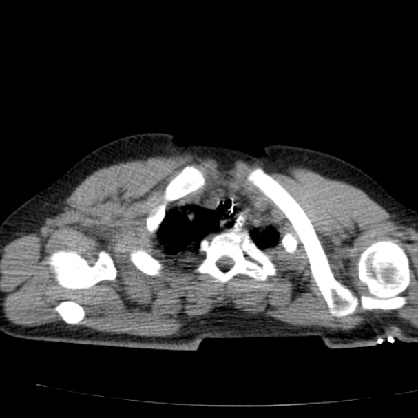 Acute aspiration pneumonitis (Radiopaedia 33605-34703 Axial non-contrast 21).jpg