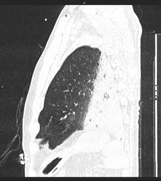 Acute aspiration pneumonitis (Radiopaedia 55642-62166 Sagittal lung window 18).jpg
