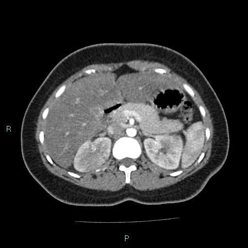 Acute bilateral pyelonephritis (Radiopaedia 37146-38881 Axial C+ arterial phase 59).jpg