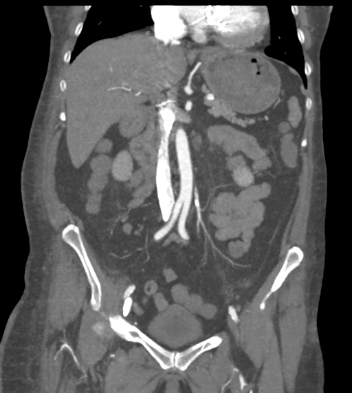 Acute bleed from gastric fundus biopsy site (Radiopaedia 35201-36737 Coronal C+ arterial phase 28).png