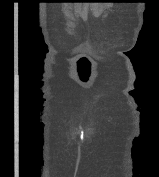 Acute bleed from gastric fundus biopsy site (Radiopaedia 35201-36737 Coronal C+ arterial phase 55).png