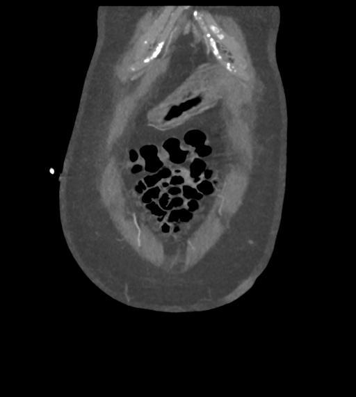 File:Acute bleed from gastric fundus biopsy site (Radiopaedia 35201-36737 Coronal C+ arterial phase 9).png