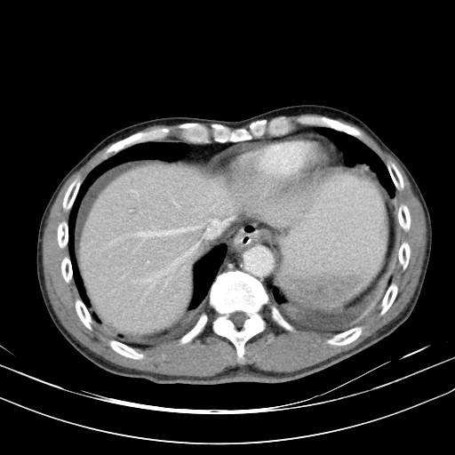 Acute bowel ischemia (Radiopaedia 87695-104114 Axial C+ portal venous phase 13).jpg