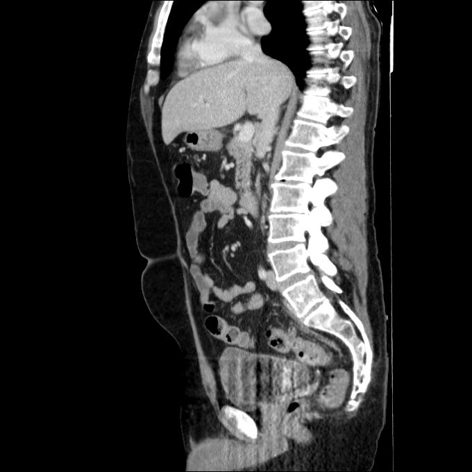 Acute cholecystitis and incidental left sided IVC (Radiopaedia 49352-54459 Sagittal C+ portal venous phase 50).jpg