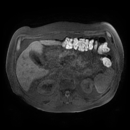 Acute cholecystitis complicated by pylephlebitis (Radiopaedia 65782-74915 Axial T1 fat sat 55).jpg
