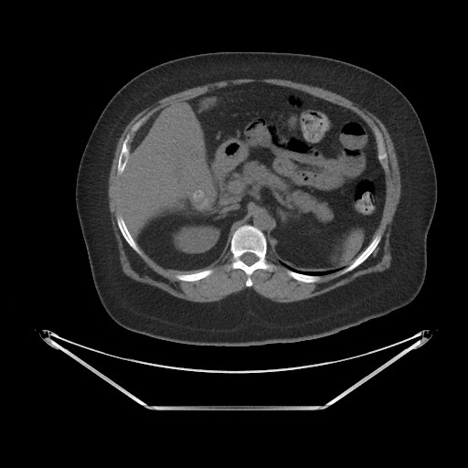 Acute cholecystitis with tensile fundus sign (Radiopaedia 71394-81723 Axial non-contrast 17).jpg