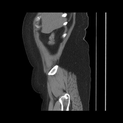 Acute cholecystitis with tensile fundus sign (Radiopaedia 71394-81723 Sagittal non-contrast 40).jpg