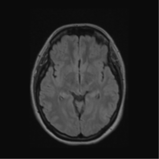 Acute disseminated encephalomyelitis (ADEM) (Radiopaedia 38073-40065 Axial FLAIR 28).png