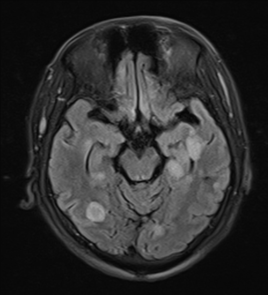 File:Acute disseminated encephalomyelitis (Radiopaedia 37253-39033 Axial FLAIR 11).jpg