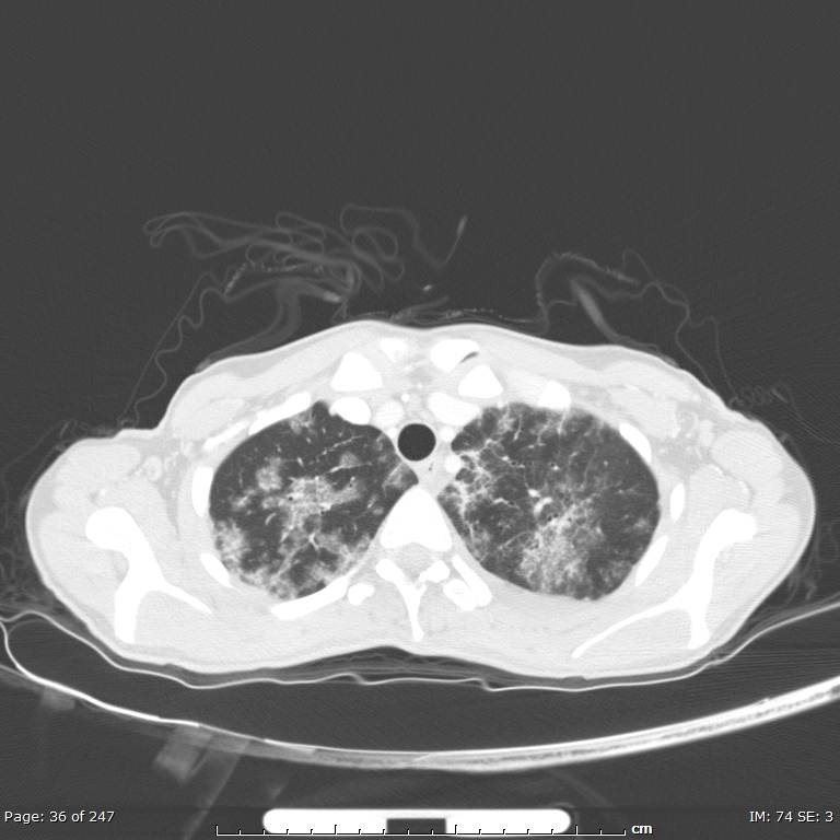 Acute eosinophilic pneumonia (Radiopaedia 48211-53073 Axial lung window 13).jpg
