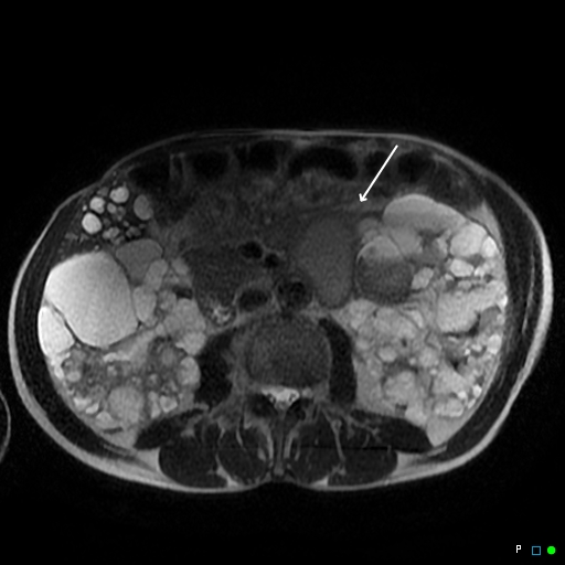 File:Acute hemorrhage in a renal cyst in polycystic disease (MRI) (Radiopaedia 41702-44642 Axial T2 1).jpg