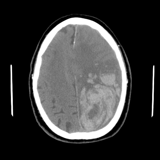 Acute hemorrhagic stroke (Radiopaedia 17507-17223 Axial non-contrast 37).jpg